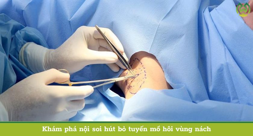 Khám phá nội soi hút bỏ tuyến mồ hôi vùng nách